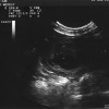 Ultraschall a 2015-08-10